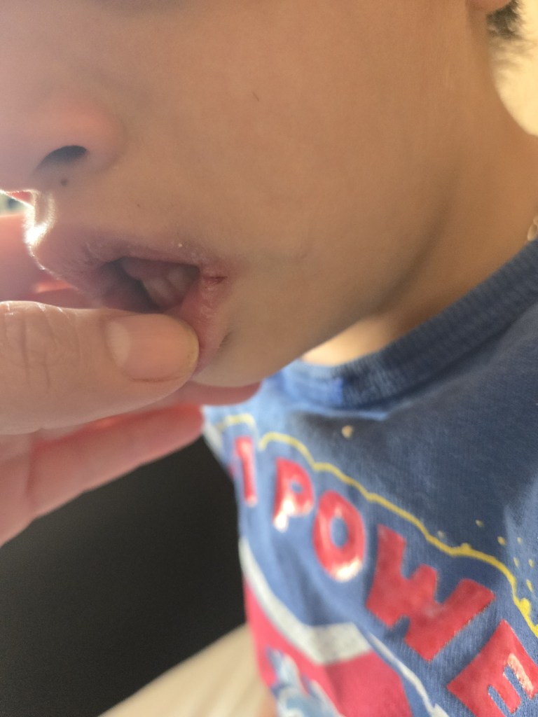 Foto que evidencia cortadas en las comisuras labiales del niño 