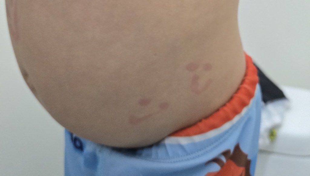 Caritas pintadas en el área abdominal y espalda baja