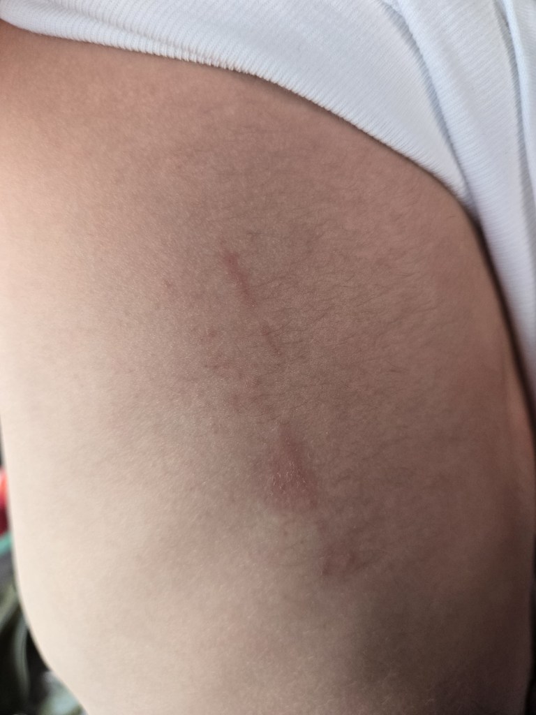 Rasguño en el costado del tórax